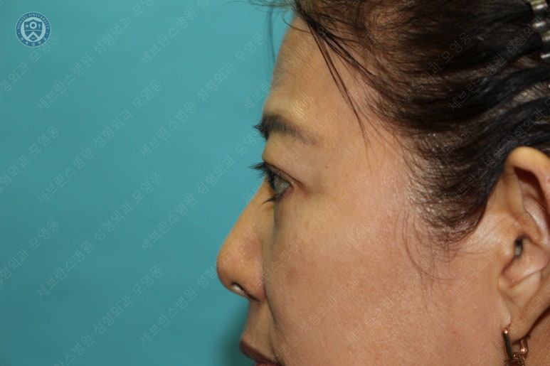 59세 여성, 그레이브스 안병증이 있는 돌출눈 중년 여성 하안검 성형술 (Lower blepharoplasty in Graves 관련 이미지 37