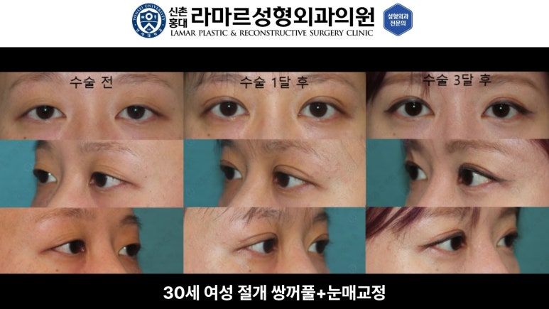 10대~30대 눈 수술 케이스 : 대표원장님 쌍꺼풀 전후 사진 모음 관련 이미지 12