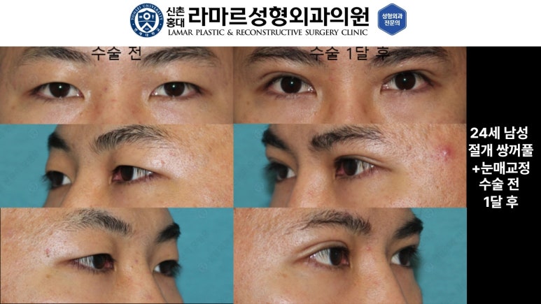 10대~30대 눈 수술 케이스 : 대표원장님 쌍꺼풀 전후 사진 모음 관련 이미지 10