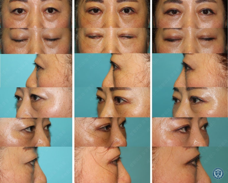 60세 여성, 상안검 및 하안검 성형술 증례 (60/F Upper & lower blepharoplasty) 관련 이미지 32