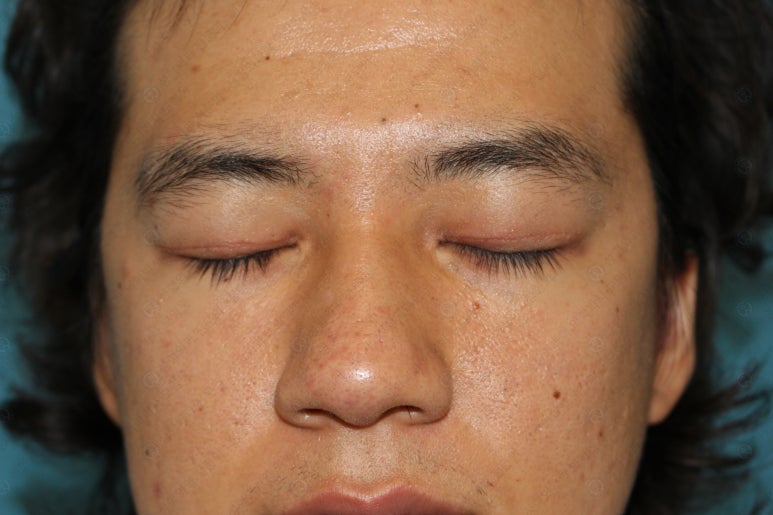 27세 남성 무쌍(속쌍)눈매교정 (27/M Ptosis correction with double lid plasty) 관련 이미지 31