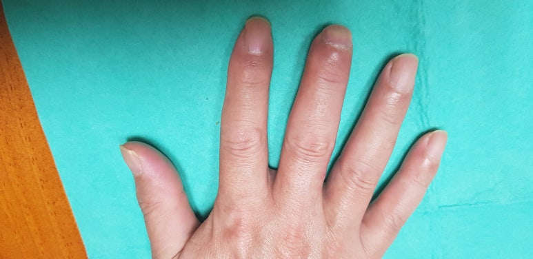 수지 말단부 절단에 시행한 동측 역행성 유경피판술 증례 (Homodigital Reverse Island Flap for Fingertip Amputation) 관련 이미지 12