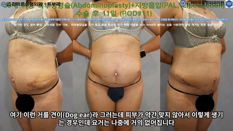 '복부성형술+지방흡입(Abdominoplasty+PAL)' 으로 뱃살 끝장내기! 관련 이미지 45