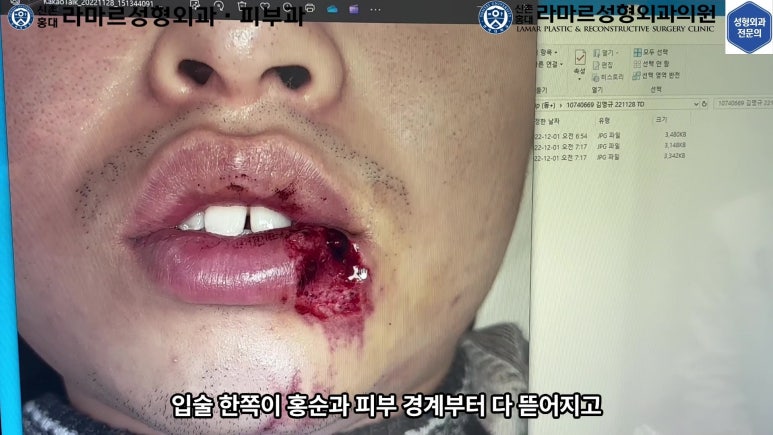 개에 물려 입술 1/3이 뜯긴 19세 남자분 치료 및 흉터 성형수술& 레이저 후기....! 관련 이미지 17