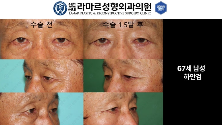 30대~80대 눈 수술 케이스 : 하안검성형술 전후 사진 모음 관련 이미지 55