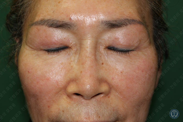 64세 여성 상안검성형술+눈매교정 (64/F Upper blepharoplasty with ptosis correction) 관련 이미지 36