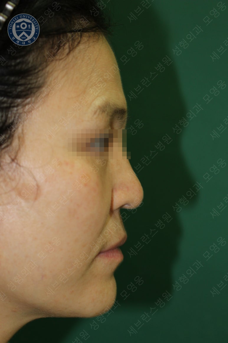 55세 여성, 이중평면 안면거상(55/F, Dual-plane full facelift) 관련 이미지 55