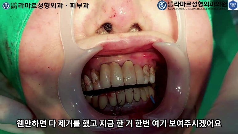 파라핀 필러 입 안 절개로 흉터없이 빼내기! 관련 이미지 86