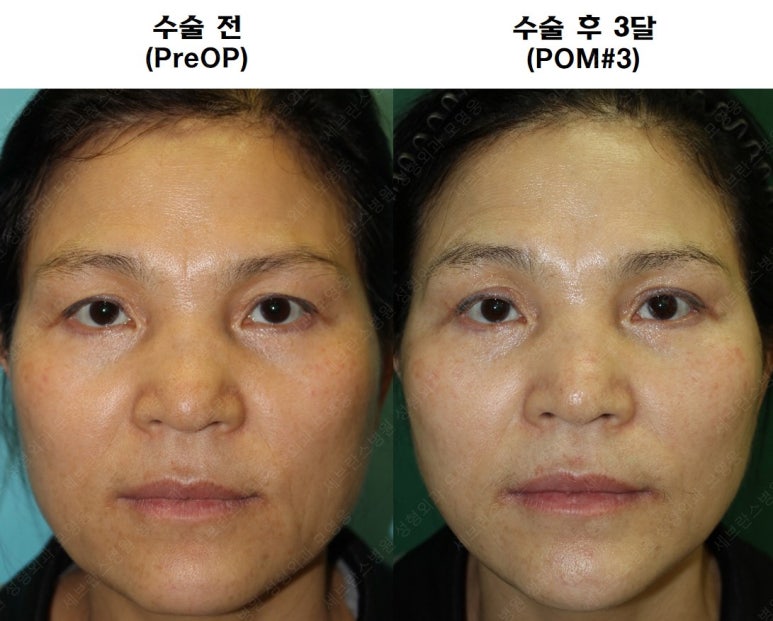 55세 여성, 이중평면 안면거상(55/F, Dual-plane full facelift) 관련 이미지 62