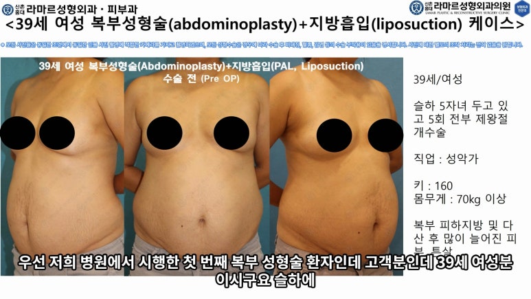 '복부성형술+지방흡입(Abdominoplasty+PAL)' 으로 뱃살 끝장내기! 관련 이미지 24