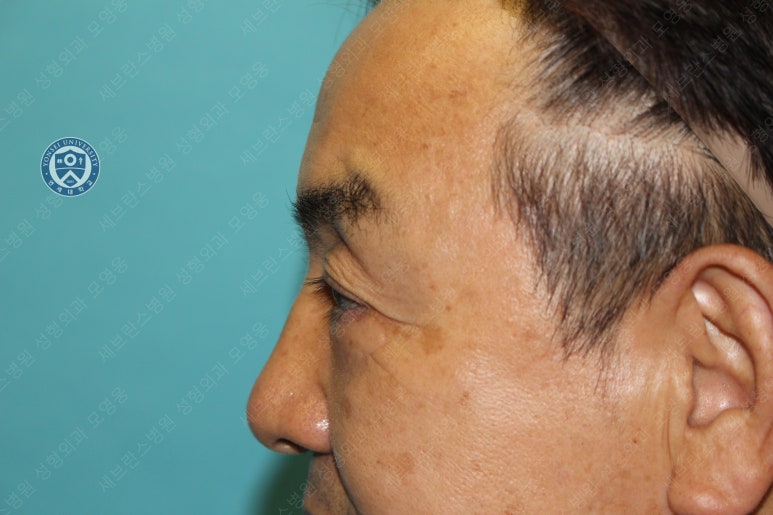 68세 남성, 하안검 성형술 및 안검외반 교정 증례(68/M Lower blepharoplasty & Ectropion correction with triamcinolone) 관련 이미지 20