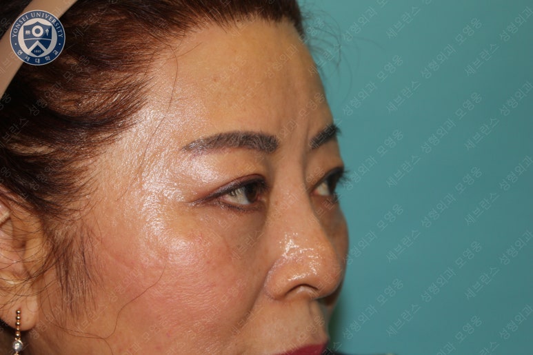 60세 여성, 상안검 및 하안검 성형술 증례 (60/F Upper & lower blepharoplasty) 관련 이미지 28