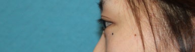 17세 여성, 쌍꺼풀+앞트임(DEO+Medial epicanthoplasty) 관련 이미지 34
