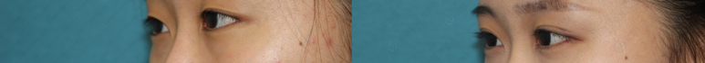 17세 여성, 쌍꺼풀+앞트임(DEO+Medial epicanthoplasty) 관련 이미지 56