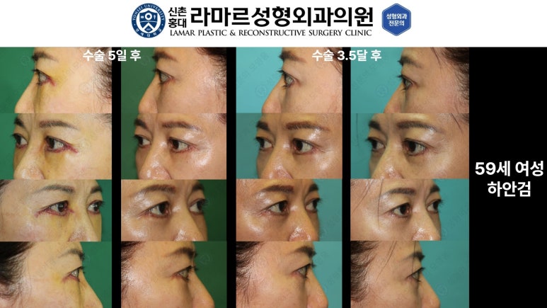 30대~80대 눈 수술 케이스 : 하안검성형술 전후 사진 모음 관련 이미지 50