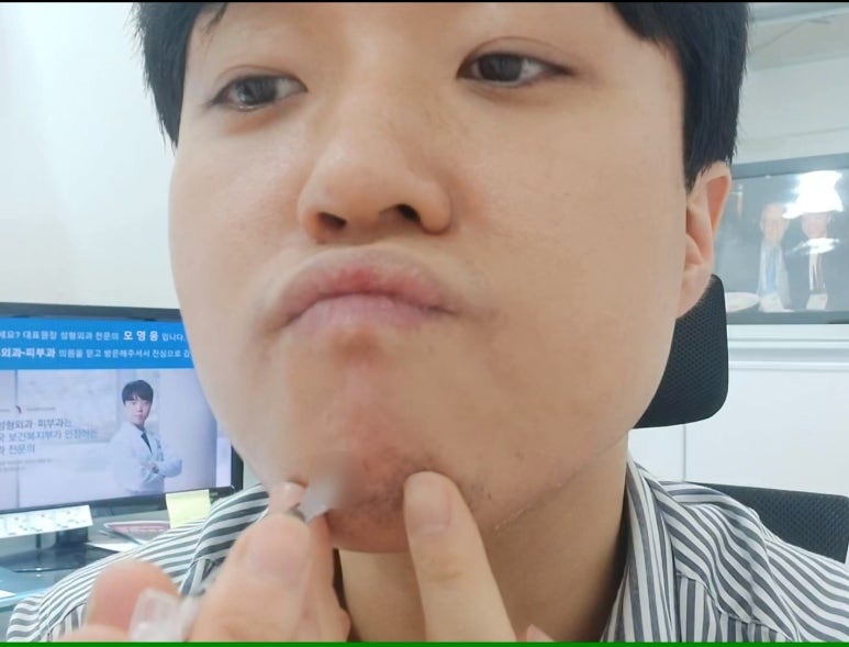 모영웅 대표원장 셀프시술 제6편! 사각턱, 침샘, 미간, 자갈턱 보톡스~! 전체 시술과정 공개합니다 관련 이미지 31
