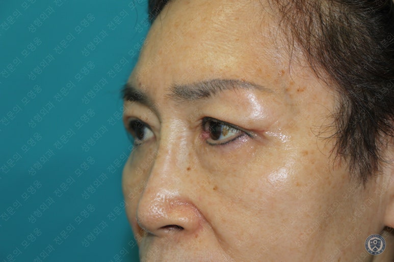 64세 여성 상안검성형술+눈매교정 (64/F Upper blepharoplasty with ptosis correction) 관련 이미지 23
