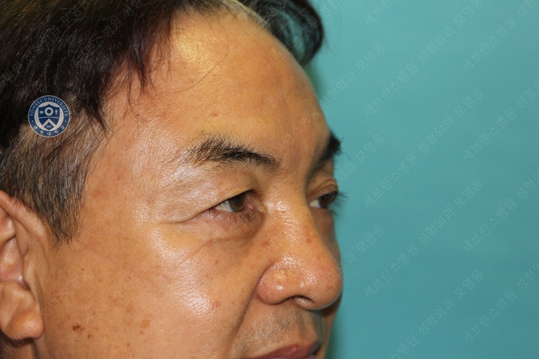 68세 남성, 하안검 성형술 및 안검외반 교정 증례(68/M Lower blepharoplasty & Ectropion correction with triamcinolone) 관련 이미지 22