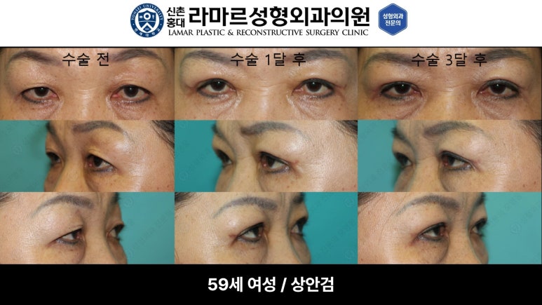 40대~80대 눈 수술 케이스 : 상안검성형술 전후 사진 모음 관련 이미지 27