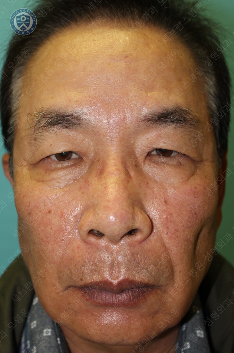 67세 남성, 상&middot;하안검성형술 및 안검하수교정 (67/M, Upper &  lower blepharoplasty with ptosis correction) 관련 이미지 2