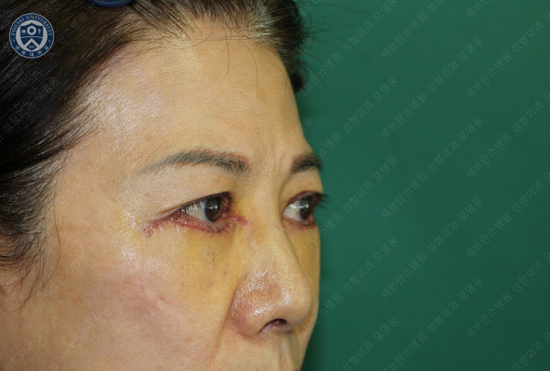 59세 여성, 그레이브스 안병증이 있는 돌출눈 중년 여성 하안검 성형술 (Lower blepharoplasty in Graves 관련 이미지 15