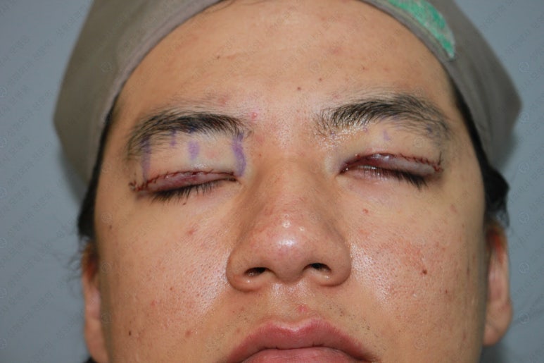 27세 남성 무쌍(속쌍)눈매교정 (27/M Ptosis correction with double lid plasty) 관련 이미지 16