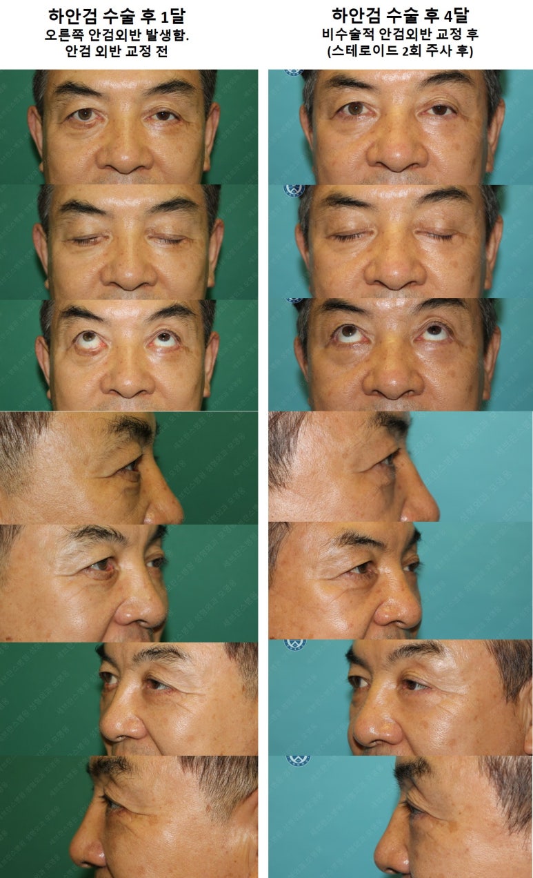 68세 남성, 하안검 성형술 및 안검외반 교정 증례(68/M Lower blepharoplasty & Ectropion correction with triamcinolone) 관련 이미지 25