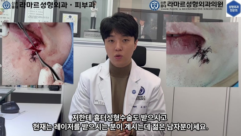 개에 물려 입술 1/3이 뜯긴 19세 남자분 치료 및 흉터 성형수술& 레이저 후기....! 관련 이미지 15
