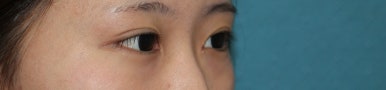 17세 여성, 쌍꺼풀+앞트임(DEO+Medial epicanthoplasty) 관련 이미지 36