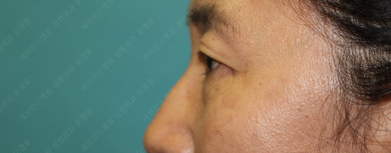 55세 여성, 상안검 및 하안검 성형술 증례 (55/F Upper & lower blepharoplasty) 관련 이미지 5