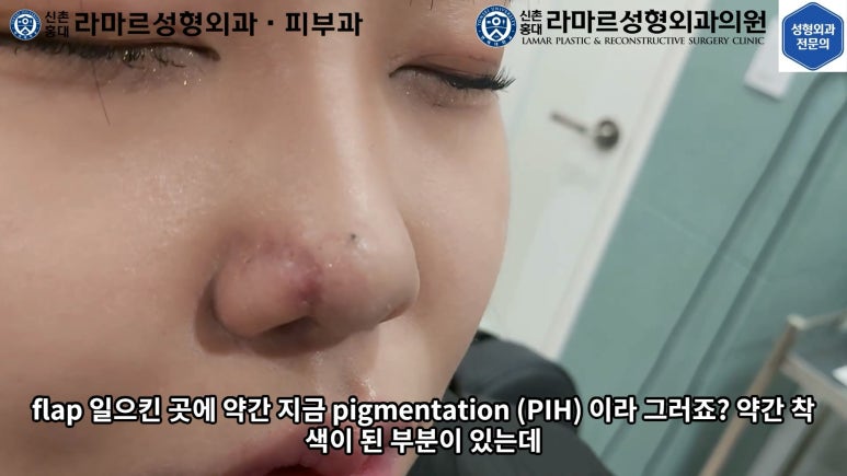 지름 1cm 코 점 제거수술 : 나선피판술(Spiral Flap) 수술전~1달 경과. (Feat. 턱끝필러+사각턱 보톡스) 관련 이미지 154