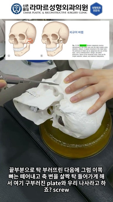 성형수술의 끝판! 성형외과 윤곽수술을 알려드립니다. 저희병원에서 사용하는 수술기구, 그리고 윤곽3종 모의수술....!! 관련 이미지 49