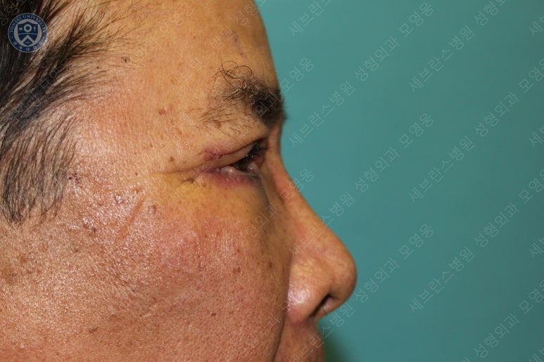 67세 남성, 상&middot;하안검성형술 및 안검하수교정 (67/M, Upper &  lower blepharoplasty with ptosis correction) 관련 이미지 27