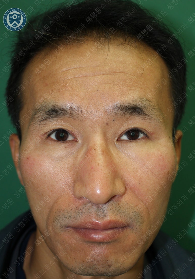 남자눈성형: 무쌍눈매교정 (Blephroptosis correction-levator aponeurosis advancement) 관련 이미지 29