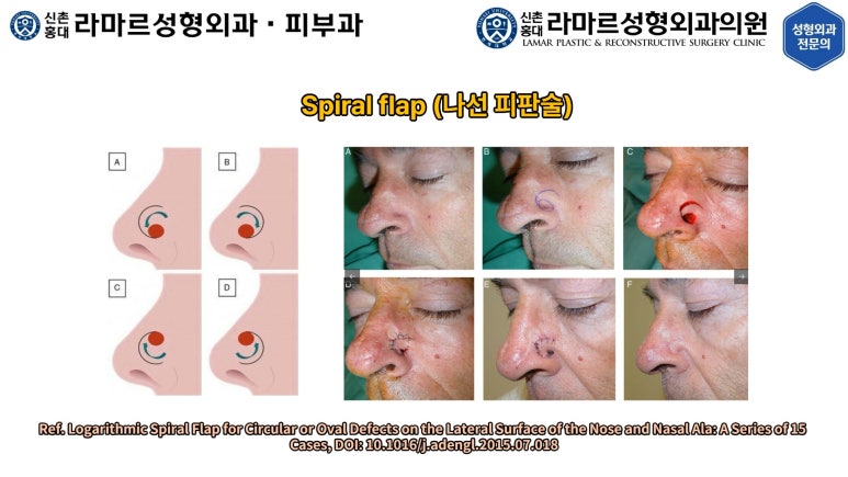 지름 1cm 코 점 제거수술 : 나선피판술(Spiral Flap) 수술전~1달 경과. (Feat. 턱끝필러+사각턱 보톡스) 관련 이미지 31