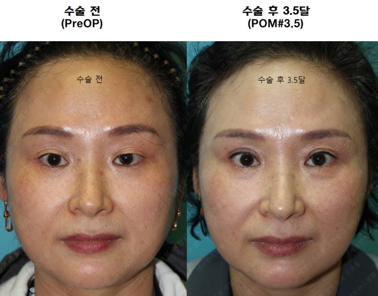 49세 여성, 토안이 있는 중년여성의 상안검성형술 (49/F, Upper blepharoplasty with lagophthalmos correction& LP) 관련 이미지 41