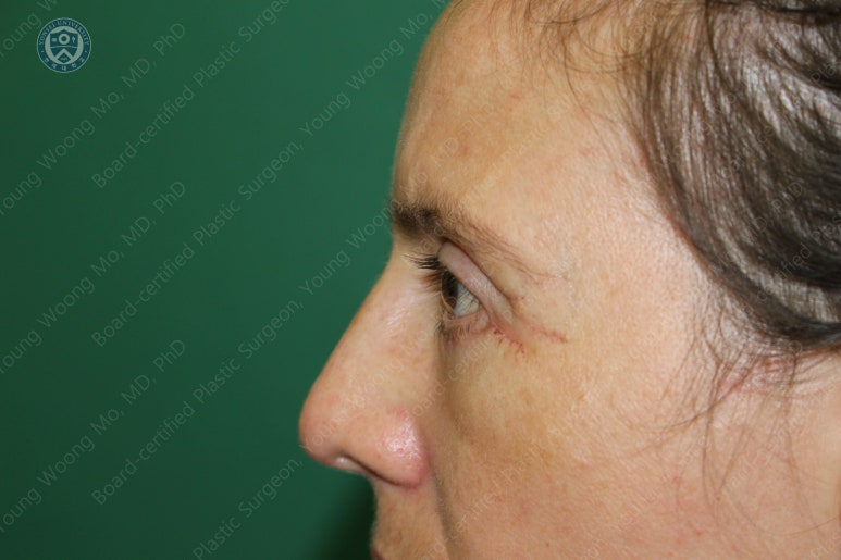 38세 서양 백인 여성, 쌍꺼풀 수술과 눈매교정 및 하안검성형술 (38/F Upper&lower blepharoplasty with levator plication) 관련 이미지 25