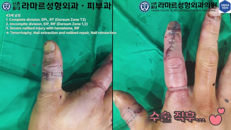 손가락 힘줄 손상 및 열상, 손톱 바닥 열상 처치 (Extensor tendon repair and nailbed injury treatment) 관련 이미지 36