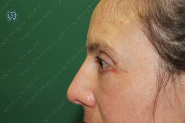 38세 서양 백인 여성, 쌍꺼풀 수술과 눈매교정 및 하안검성형술 (38/F Upper&lower blepharoplasty with levator plication) 관련 이미지 33