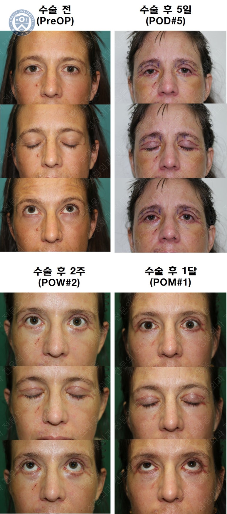 38세 서양 백인 여성, 쌍꺼풀 수술과 눈매교정 및 하안검성형술 (38/F Upper&lower blepharoplasty with levator plication) 관련 이미지 40