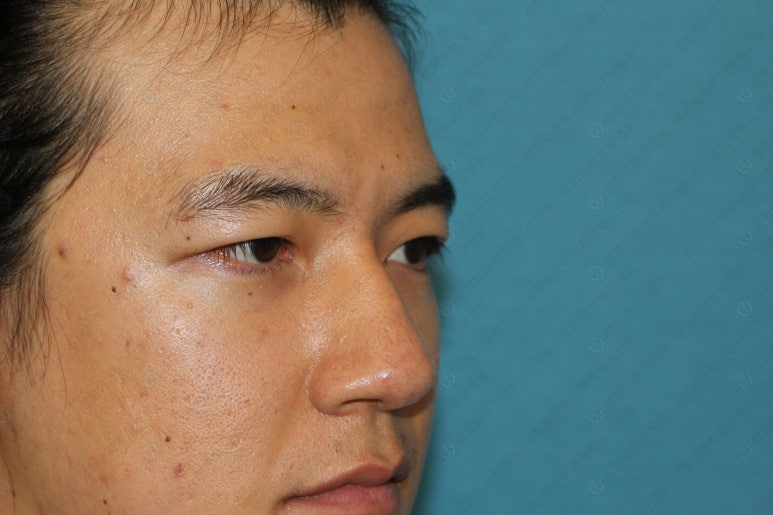 27세 남성 무쌍(속쌍)눈매교정 (27/M Ptosis correction with double lid plasty) 관련 이미지 36