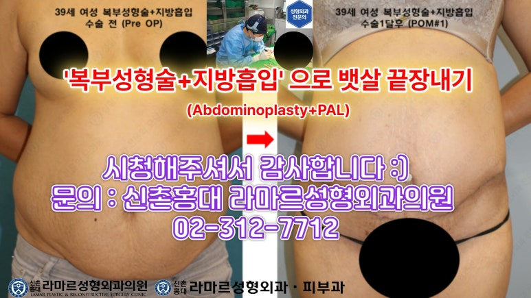 '복부성형술+지방흡입(Abdominoplasty+PAL)' 으로 뱃살 끝장내기! 관련 이미지 64