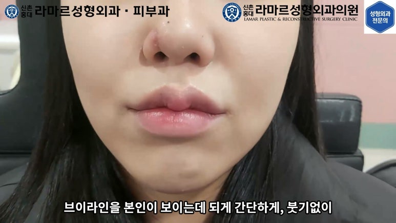지름 1cm 코 점 제거수술 : 나선피판술(Spiral Flap) 수술전~1달 경과. (Feat. 턱끝필러+사각턱 보톡스) 관련 이미지 160