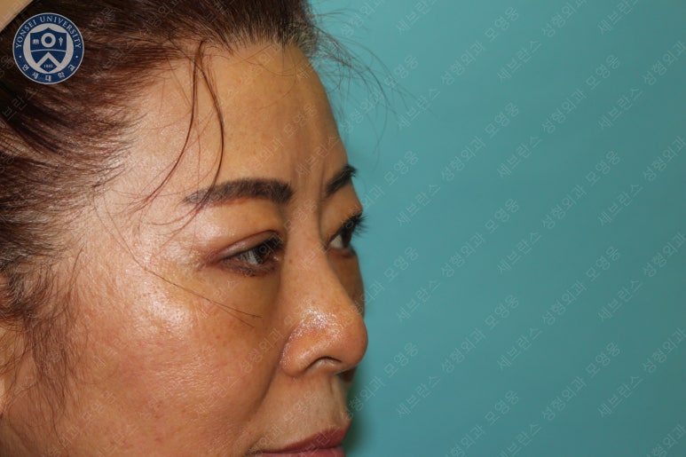 60세 여성, 상안검 및 하안검 성형술 증례 (60/F Upper & lower blepharoplasty) 관련 이미지 20
