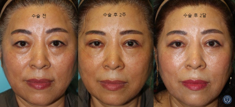 60세 여성, 상안검 및 하안검 성형술 증례 (60/F Upper & lower blepharoplasty) 관련 이미지 31