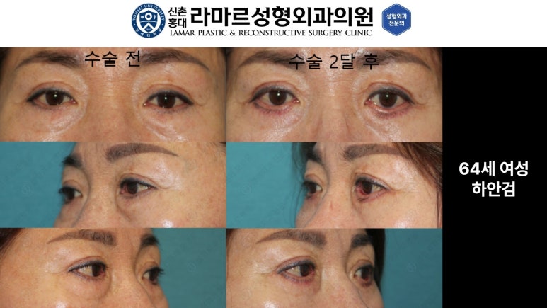 30대~80대 눈 수술 케이스 : 하안검성형술 전후 사진 모음 관련 이미지 28