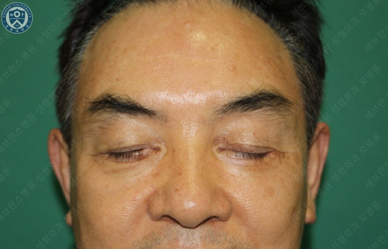 68세 남성, 하안검 성형술 및 안검외반 교정 증례(68/M Lower blepharoplasty & Ectropion correction with triamcinolone) 관련 이미지 7