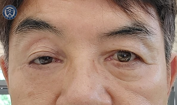 68세 남성, 하안검 성형술 및 안검외반 교정 증례(68/M Lower blepharoplasty & Ectropion correction with triamcinolone) 관련 이미지 15