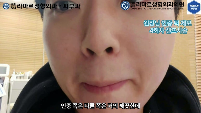 [성형외과 전문의의 셀프시술 제8편] 인중, 아래턱 제모 4회차 결과 공개! 관련 이미지 94