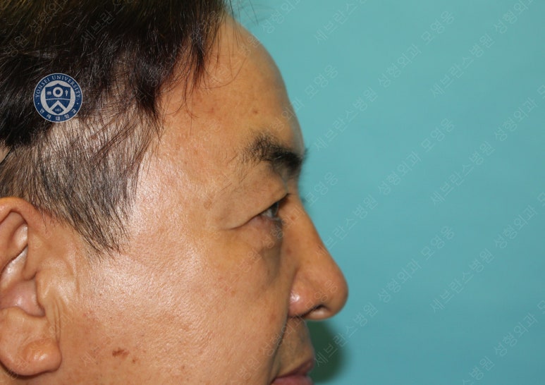 68세 남성, 하안검 성형술 및 안검외반 교정 증례(68/M Lower blepharoplasty & Ectropion correction with triamcinolone) 관련 이미지 23
